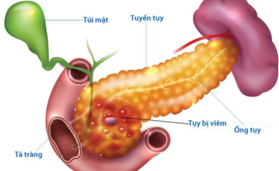 Bệnh viêm tụy: nguyên nhân, triệu chứng, chẩn đoán, điều trị, phòng ngừa
