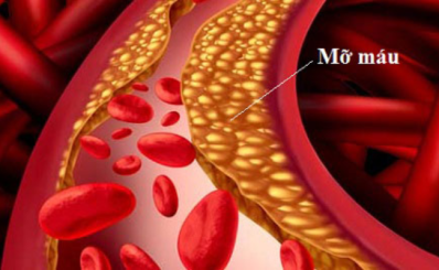Cách giảm mỡ máu tự nhiên